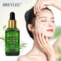 Breylee Acne Treatment Face Serum | Breylee Acne Serum Before and After