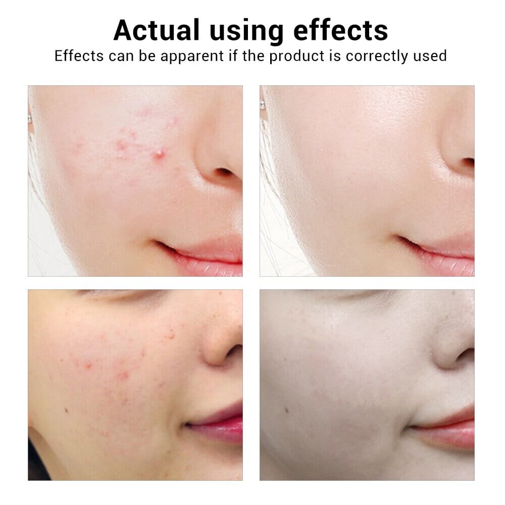 Breylee Acne Treatment Face Serum | Breylee Acne Serum Before and After