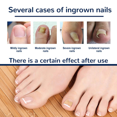 Nail Correction Patch | Best Nail Repair Patch
